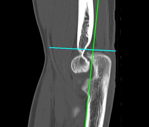 Scan to include distal Humerus through proximal
