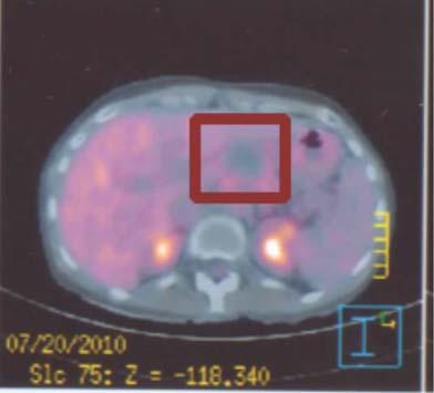 Figure 4. Pet scan of the Figure 2.