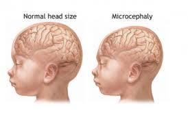 ZIKV Effects In Pregnancy What Is Microcephaly?