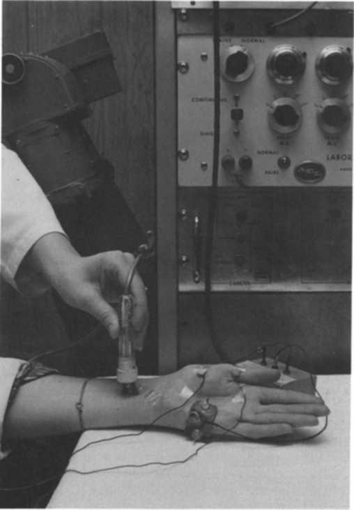 218 CANADIAN ANAESTHETISTS' SOCIETY JOURNAL FIGURE 1. Placement of cutaneous electrodes over the opponens pollicis muscle, with stimulation of the median nerve.
