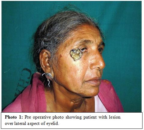 IV. Case Report A 55 year old female patient presented with swelling over the left lower eyelid and lateral periorbital area.