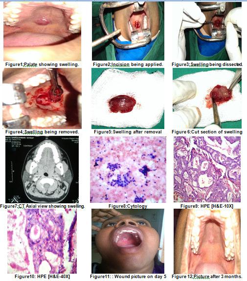 DISCUSSION Epithelial neoplasms of minor salivary glands consist of about 15% of all neoplasms of salivary glands.(3,4) It is more common in females(5) and tends to occur before 18 years of age(6).