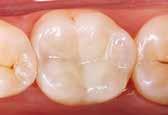 5 % by 1 volume), it is possible to fill large cavities reliably and with 0.