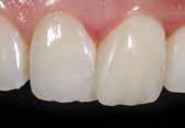 situations 4 opaque dentine shades allow highly aesthetic layer system working Clinical Cases