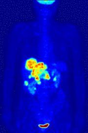 Staging PET scan Treatment