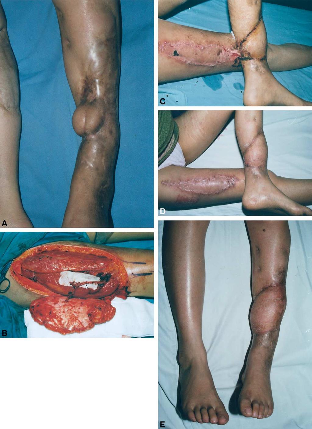 The earlier clinic experience of the reverse-flow anterolateral thigh island flap 163 Figure 3 The treatment of the distal leg soft tissue defects with the reverse