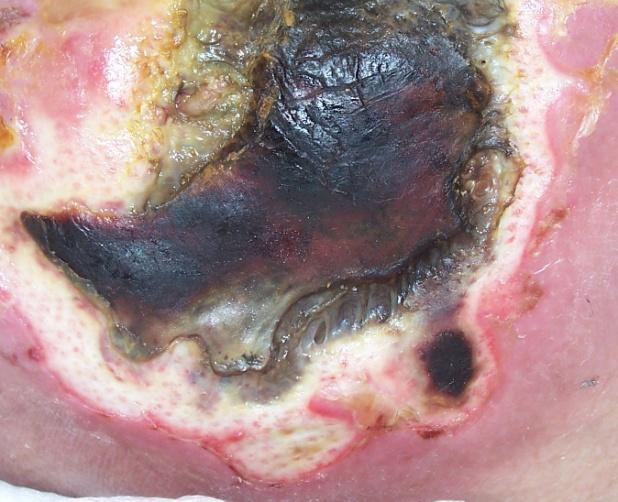 Unstageable Pressure Injury: Obscured Full-thickness Skin And Tissue Loss Full-thickness skin and tissue loss in which the extent of tissue damage within the ulcer cannot be confirmed because it is