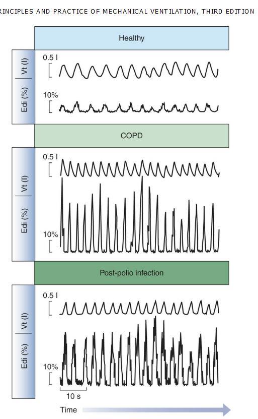 EAdi in the Adult: Health and Disease Sinderby & Beck, Neurally Adjusted Ventilatory Assist in