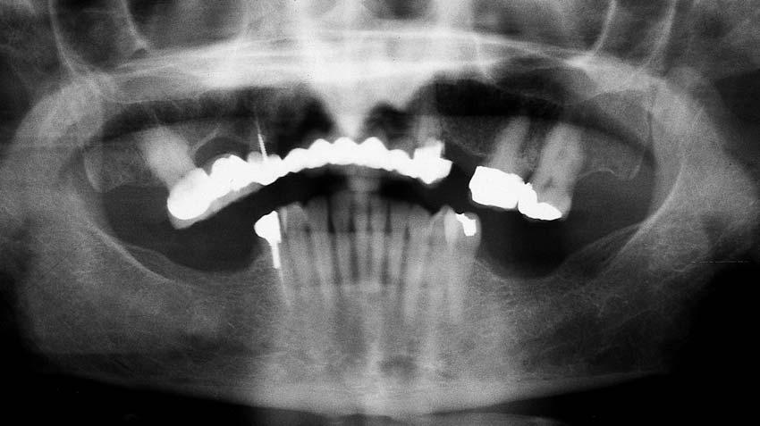 CASE REPORTS ON INTERIM DENTURES FIGURE 1. Panoramic radiograph of 56-year-old woman before fabrication of partial interim prosthesis.