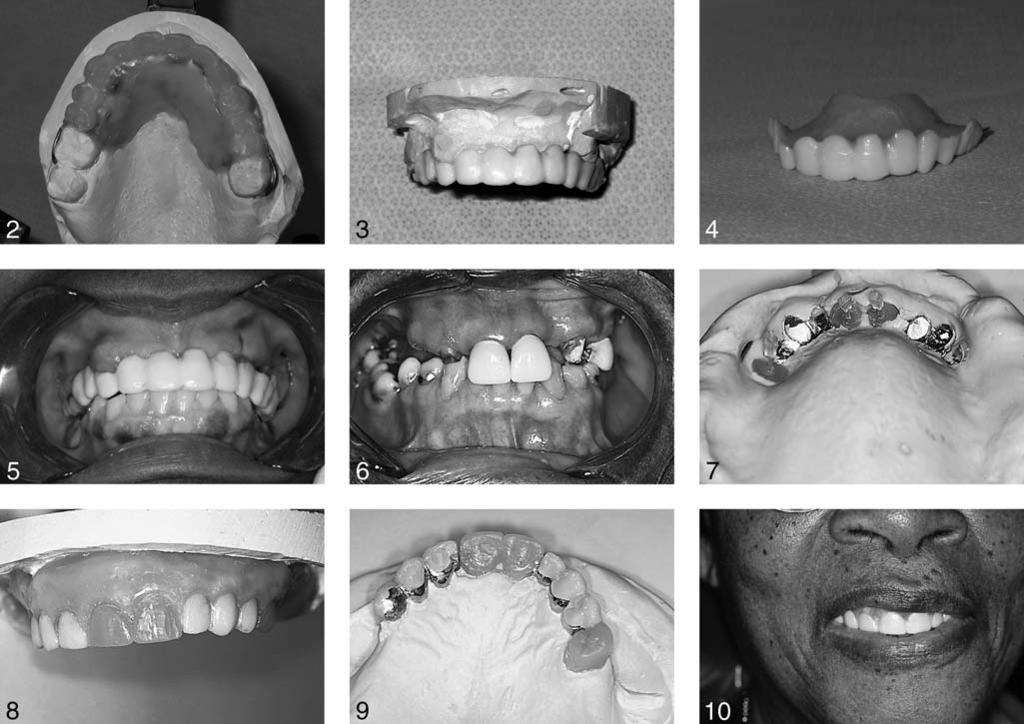Sheldon Winkler et al FIGURES 2 10. Waxed prosthesis on master cast. Note the wrought wire clasps on the 2 maxillary first molars. FIGURE 3.