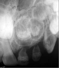 Periapical Radiograph Showing the