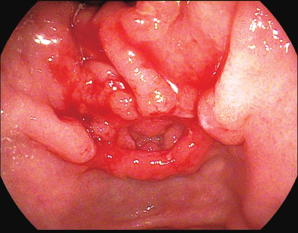 Lee Y et al. Inverted Early Gastric Cancer C Fig. 1. Esophagogastroduodenoscopy and endoscopic ultrasound.