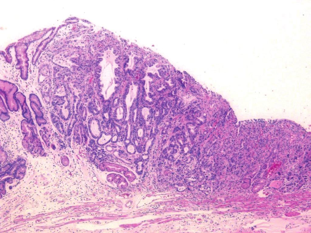 Lee Y et al. Inverted Early Gastric Cancer Fig. 3. Histologic features of the resected specimen.