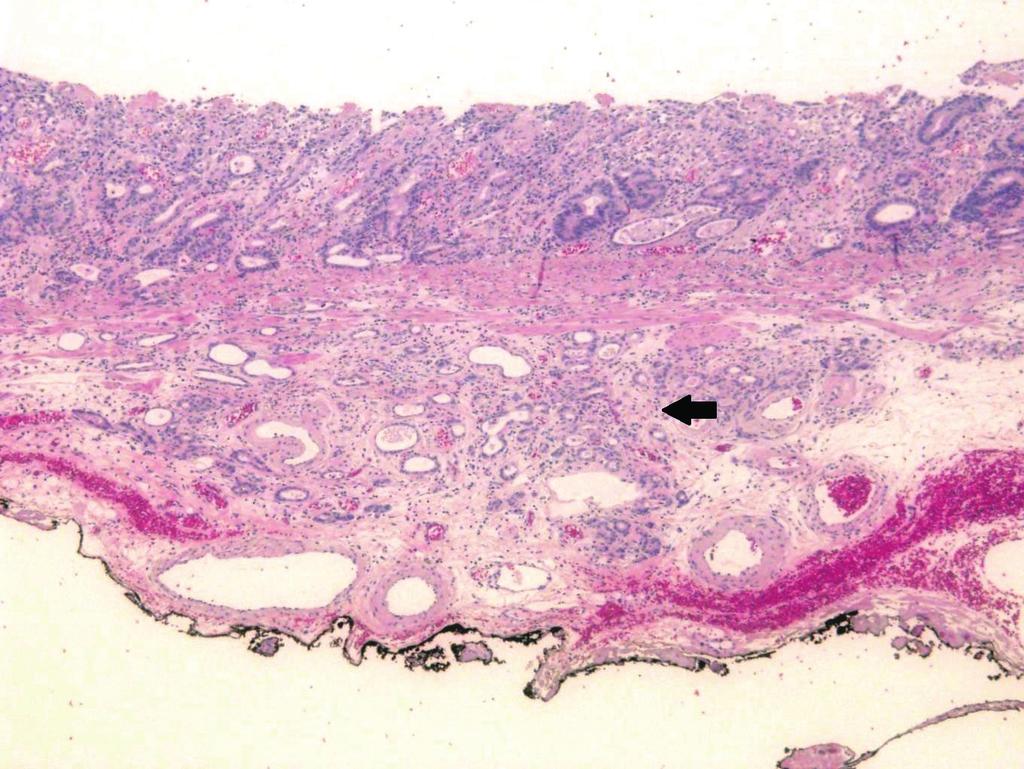 () The tumor invading the submucosal layer (black arrow). The depth of submucosal invasion is 450 μm. The safety margin of the base is 150 μm (black ink; H&E stain, 40).