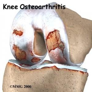 Persistent Pain After Knee and Hip Arthroplasty is