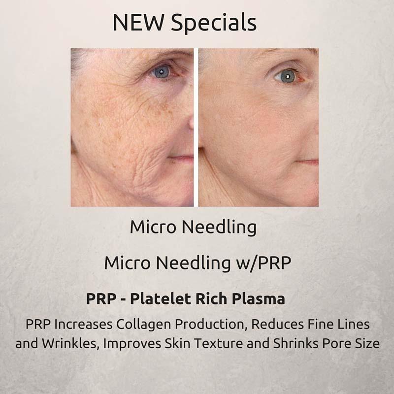 Page 5 of 5 Combining microneedling with the body's own Platelet Rich Plasma (PRP) boosts the healing process.