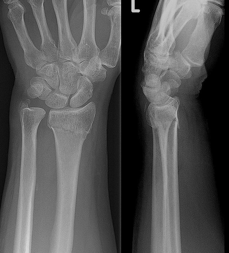 A distal radial fracture (wrist