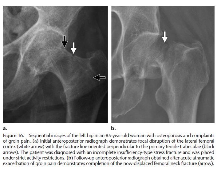 A femoral neck/hip fracture-much