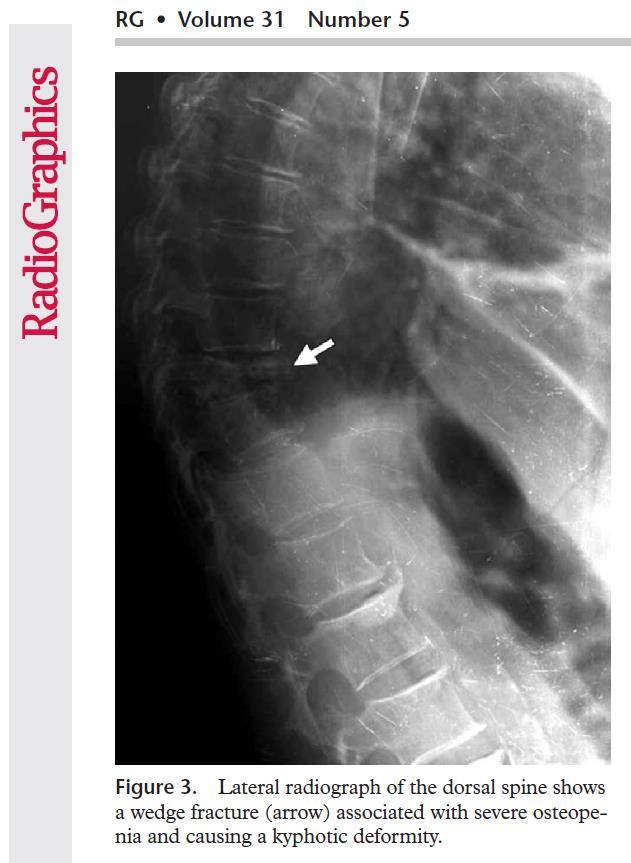 A severe spinal compression fracture-they can be much