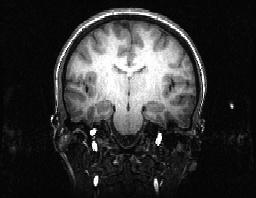Functional MRI (fmri) images brain function uses same hardware as MRI