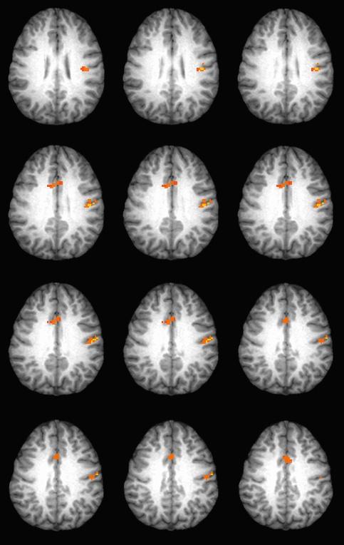 fmri R L Brain activation during word repetition From: Shuster, L., Moore, D., Chen, G., Ruscello, D. & Wonderlin, W.