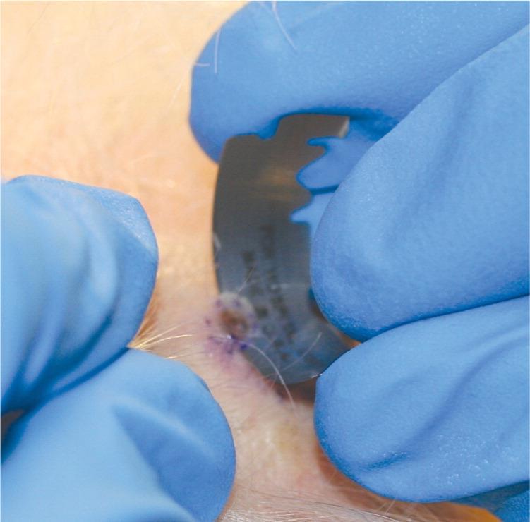 Shave Biopsy Enter the skin tangentially and cut underneath the lesion parallel to the skin To the depth of the reticular dermis Brought
