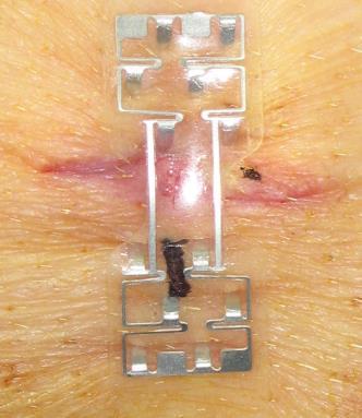Excellent wound approximation was achieved using the micromend device.