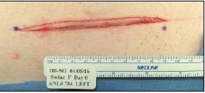 Figure 3: Trochar wound and micromend closure A) Trochar insertion B) Port site wound C) micromend closure Specific