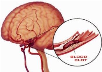 Thrombosis is the clotting of blood from damaged