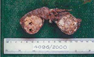 of follicular adenoma and carcinoma was in the rd and 4 th decade respectively. The SNTs were commoner in females with a F: M ratio of 6.