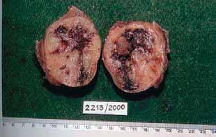 Gross ndings: Out of the 00 specimens, eight were resected solitary nodules and the remaining were partial thyroidectomy, hemithyroidectomy and lobectomy specimens.
