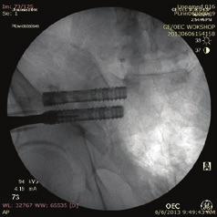 15a) Second Implant Insertion Fig. 16a Fig.