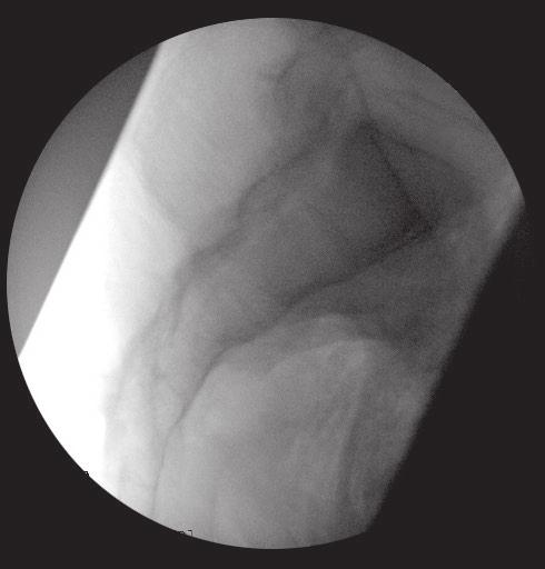 Sacral Wall Sacral Notch SI Joint Sacral Canal S1