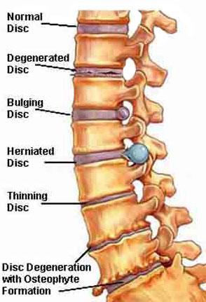 Bulging Disc 1. Caused by excessive lumbar extension 3. Disc herniation 1. Axial loading plus LCS increases risk of herniation 4. Pinched nerve (Sciatica) 1. Pressure from tight piriformis 2.