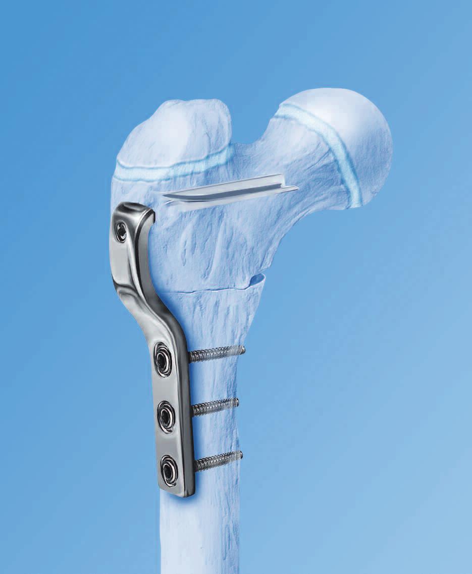 Cannulated Pediatric Osteotomy System (CAPOS). A single system of osteotomy blade plates and cannulated instrumentation.