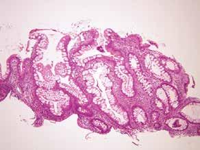 Serrated Epithelial Change SEC is a histologic finding in patients with long-standing colitis.
