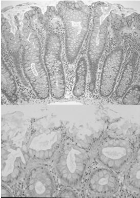 proliferation Sessile serrated adenoma/polyp 2. Dysplastic Serrated Polyps Sessile serrated polyp with dysplasia Serrated adenoma (traditional) Conventional adenoma with serrated architecture 3.