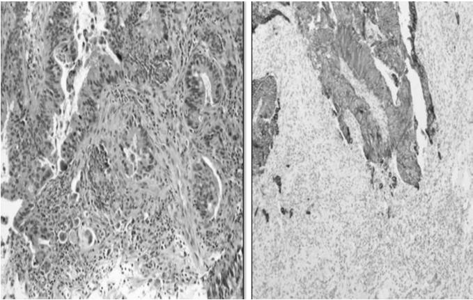 Tumor Budding Tumour budding Identified as a significant prognostic factor in several papers Ueno et al Gastroenterology 2004;127:385-94 Tateishi et al Mod Path 2010;1:1-5 Sohn et al J Clin Pathol