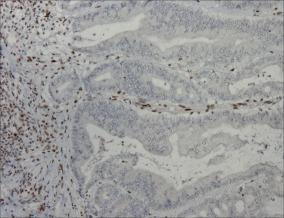 IHC Abnormal: MLH1 and