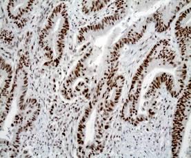 IHC Abnormal: MSH2 and