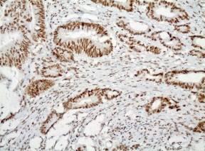 IHC Abnormal: MSH6 or