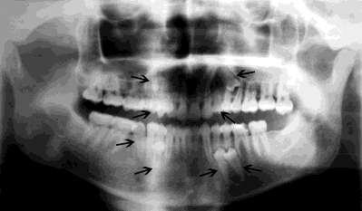 supernumerary teeth Epidermal cysts, lipomas