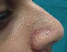 keratoses and oral papillomas are typical manifestations Predisposed to multiple