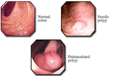 Endoscopic Appearance of Colonic Polyps Polyps may be classified