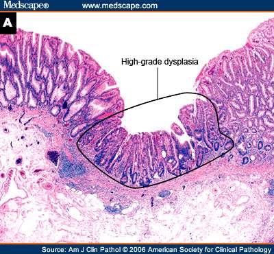 Pathology of Colonic Polyps All adenomas are dysplastic, but are graded as having either highgrade or low-grade dysplasia