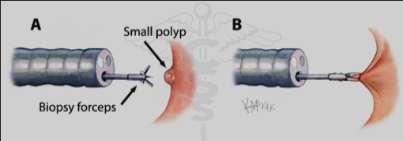 Management of Colonic Polyps When a polyp is detected,