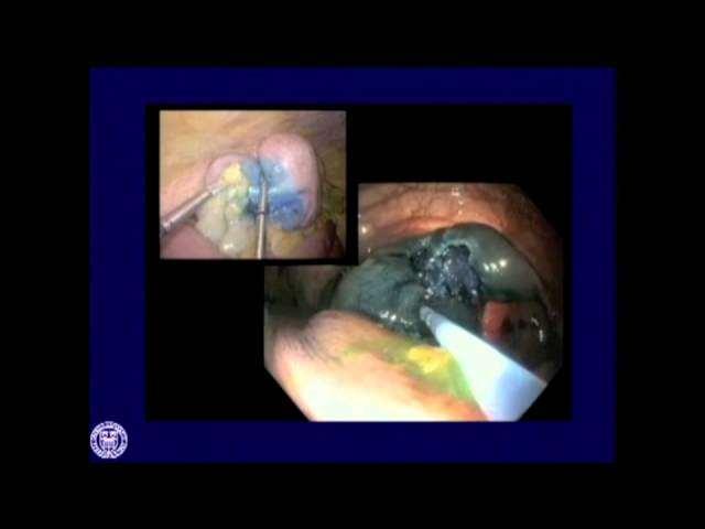 Management of Colonic Polyps A new approach to previously unresectable polyps is to combine the endoscopic resection with