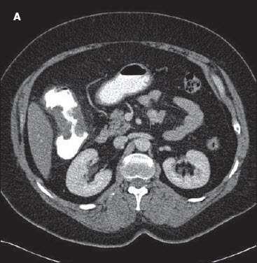 CT colonography or colonoscopy may be utilized