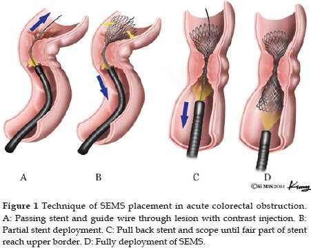 perforation and bleeding Surgical options include primary resection and anastomosis, diverting ostomy and surgical