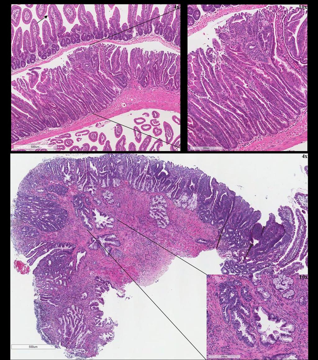 Figure 6.10 H&E stained sections of TSA and adenocarcinoma in BRaf VE /p16 null mice.